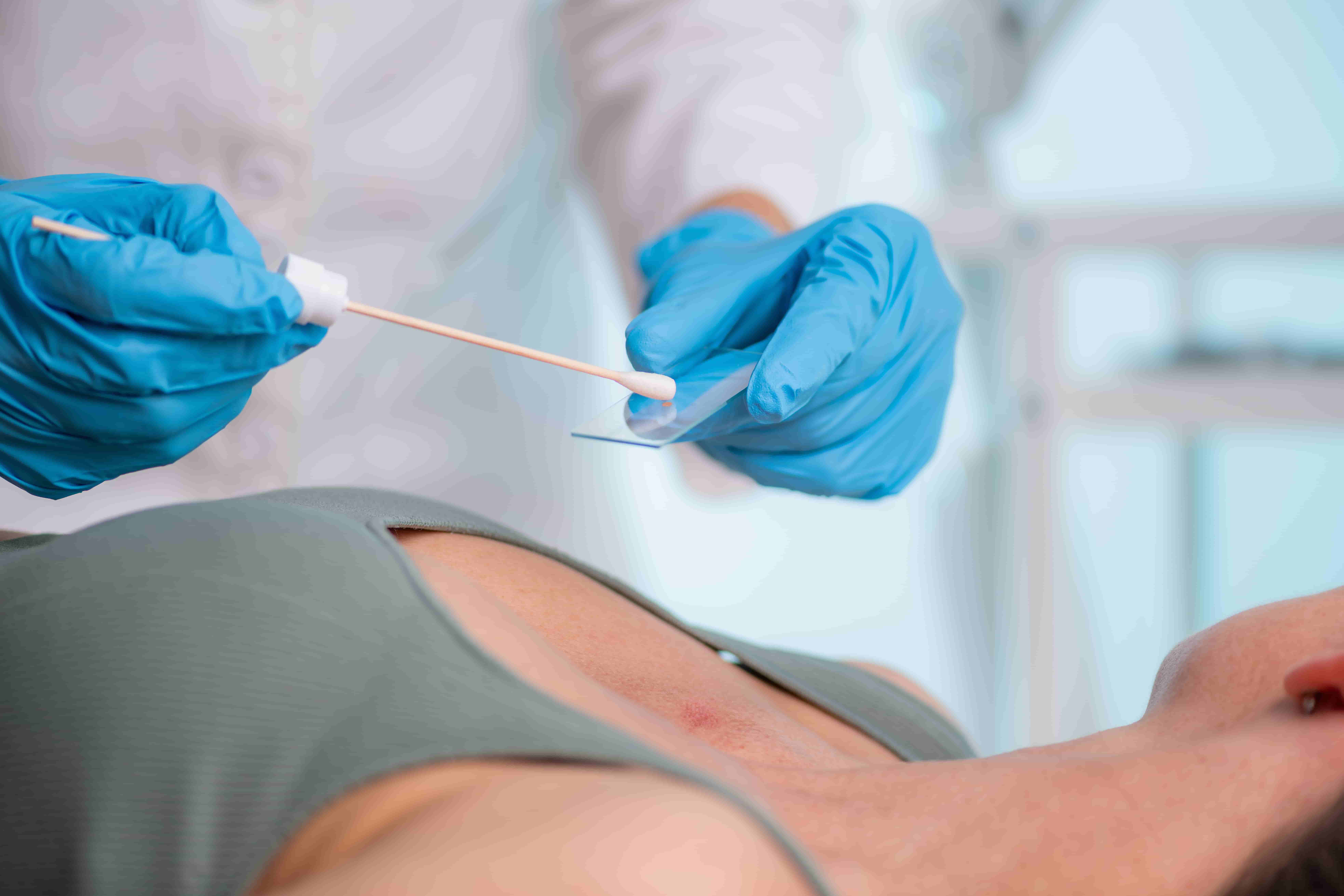 Dépistage du cancer du col de l'utérus : quand et pourquoi consulter