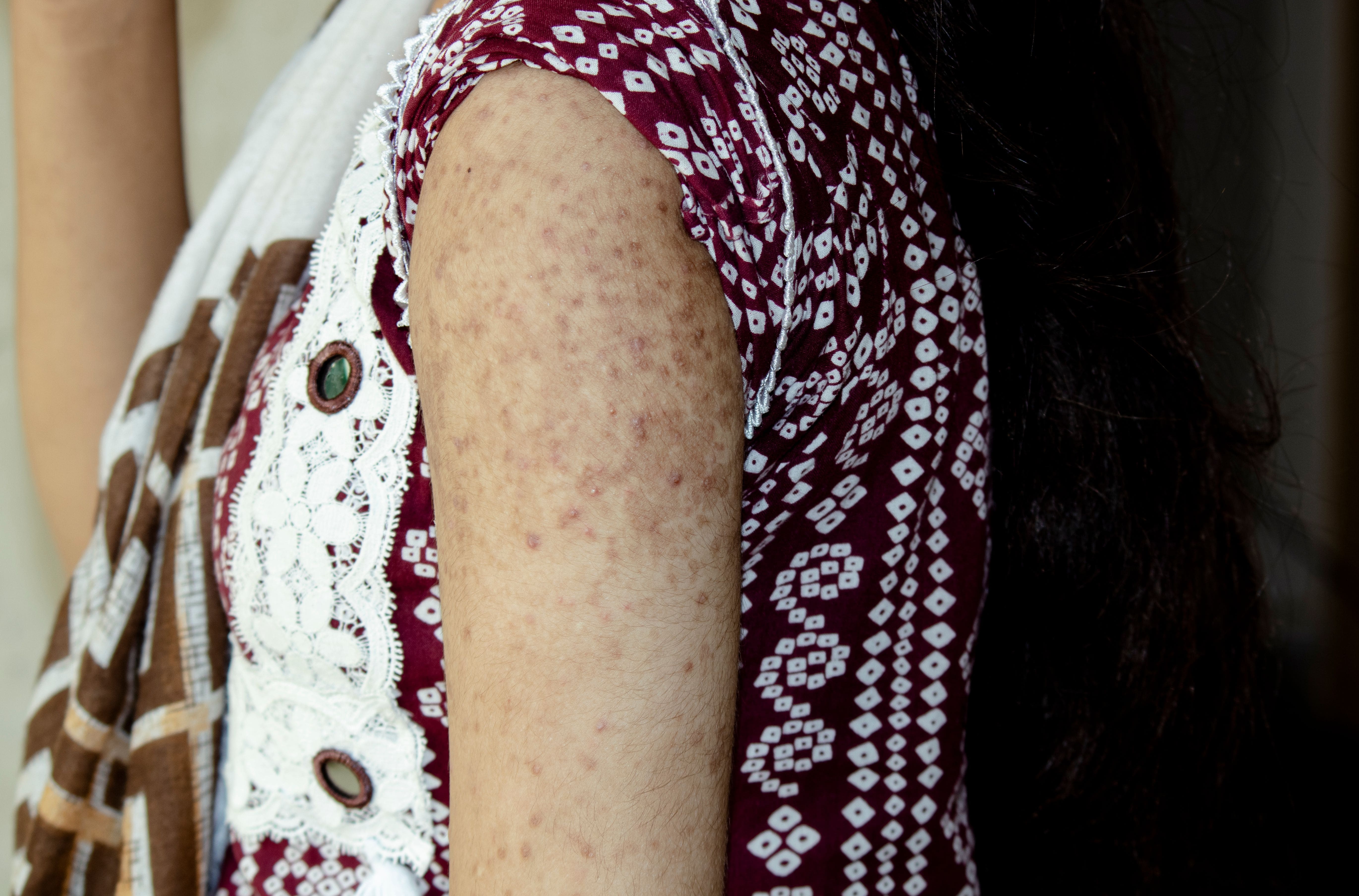 closeup-of-a-flaky-rash