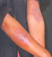 eczema