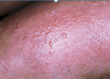 eczema