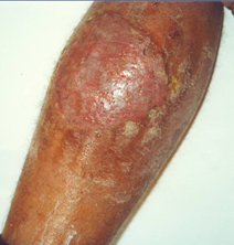 eczema