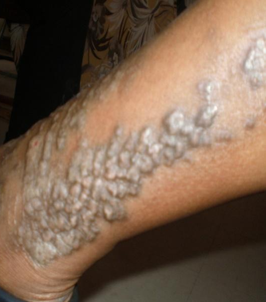 eczema