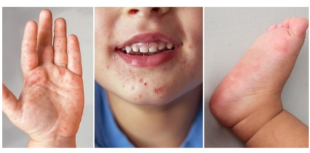 PIEDS-MAINS-BOUCHE